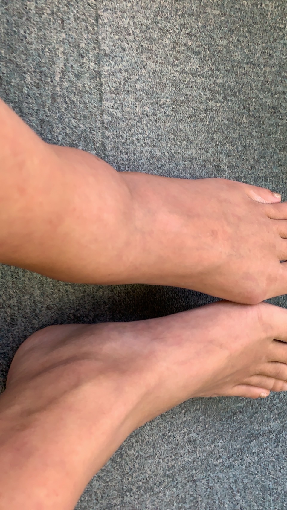 痛風で腫れた足